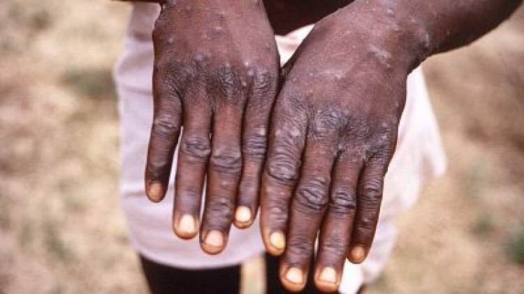 Brote de viruela del mono relacionado con un evento de superpropagación en la sauna para adultos