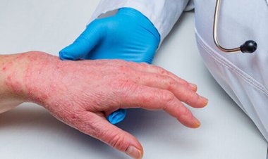 La viruela del mono es un arma biológica