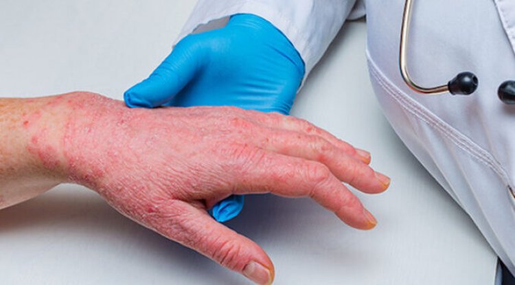 La viruela del mono es un arma biológica