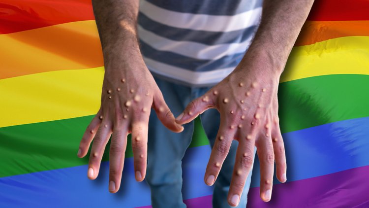 La viruela del mono es una enfermedad gay