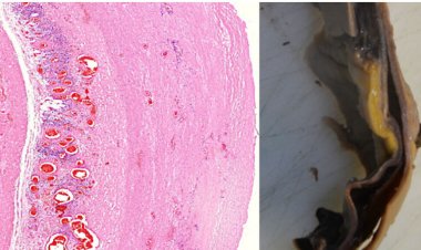 “Prueba irrefutable” de que las vacunas de ARNm causan daño vascular y en órganos