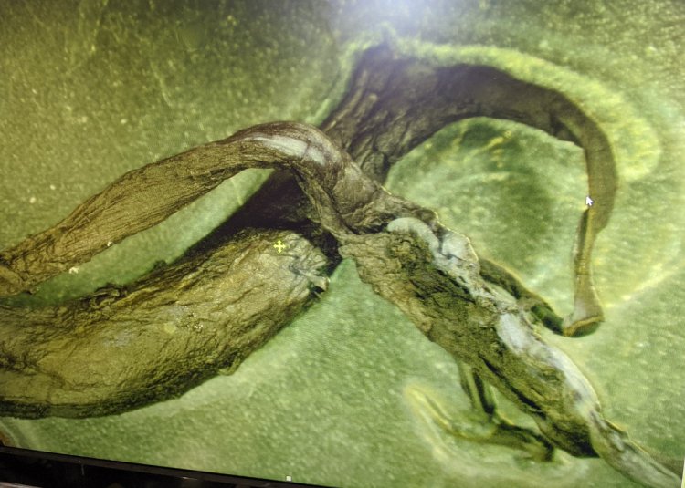 Embalsamadores encuentran coágulos FOOTLONG en cadáveres de los completamente vacunados