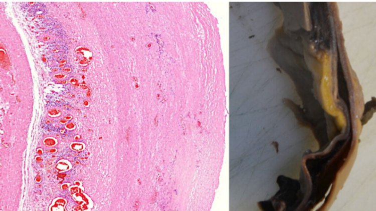“Prueba irrefutable” de que las vacunas de ARNm causan daño vascular y en órganos