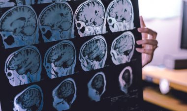 Parkinson causada por las vacunas