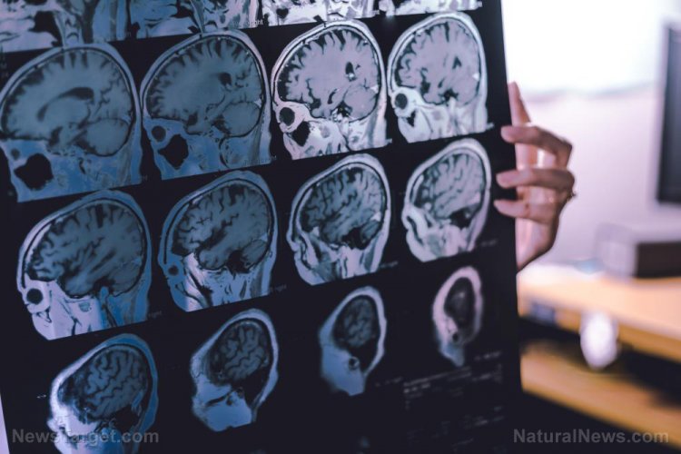 Parkinson causada por las vacunas