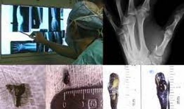 Abducciones e implantes