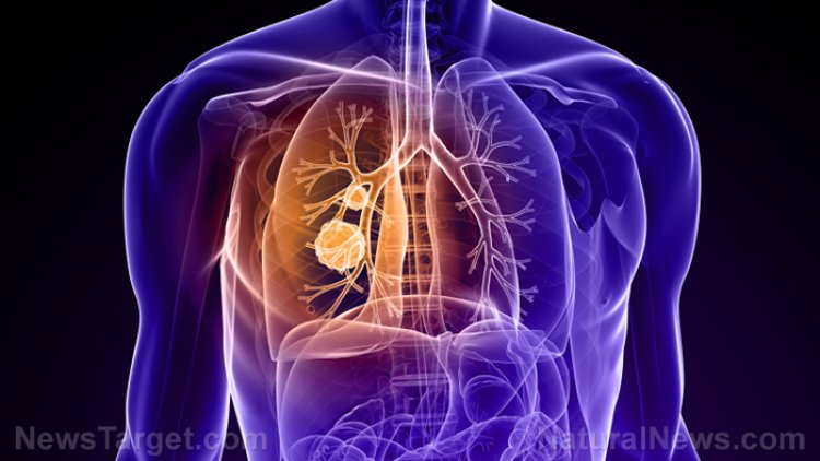 ¿Qué PROPAGA el cáncer más rápido?
