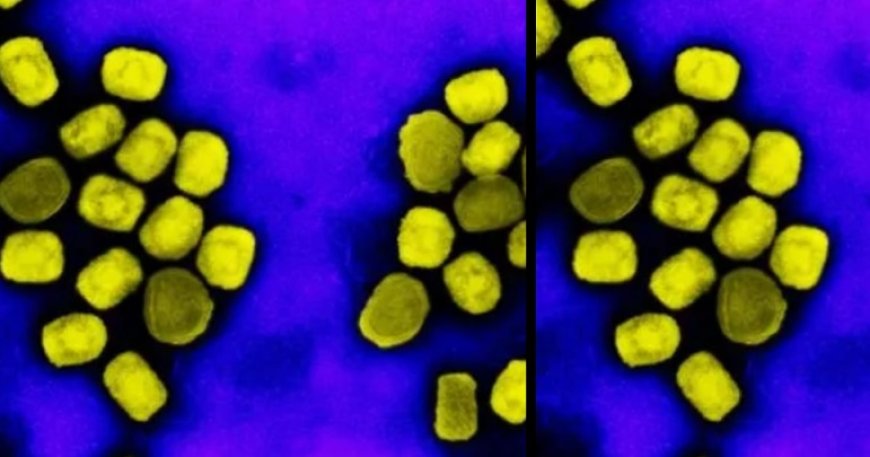 Los PCR no pueden diagnosticar las infecciones por viruela símica