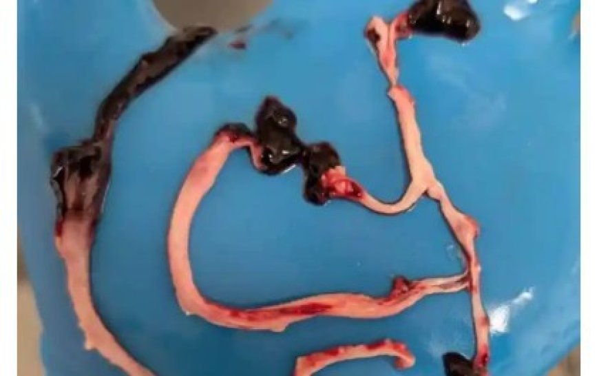 Coágulos rde sangre encontrados en hijos de madres vacunadas COVID-19