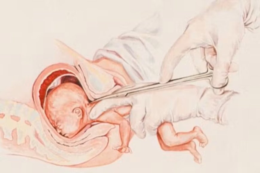 Los abortos de los bebés